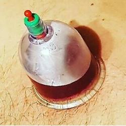 kilburn 1 day hijama cupping massage diploma beauty clinic certificate mobile training uk hot fire