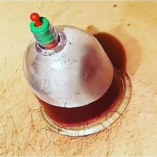 kilburn 1 day hijama cupping massage diploma beauty clinic certificate mobile training uk hot fire