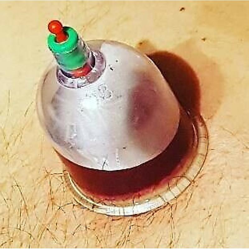 kilburn 1 day hijama cupping massage diploma beauty clinic certificate mobile training uk hot fire